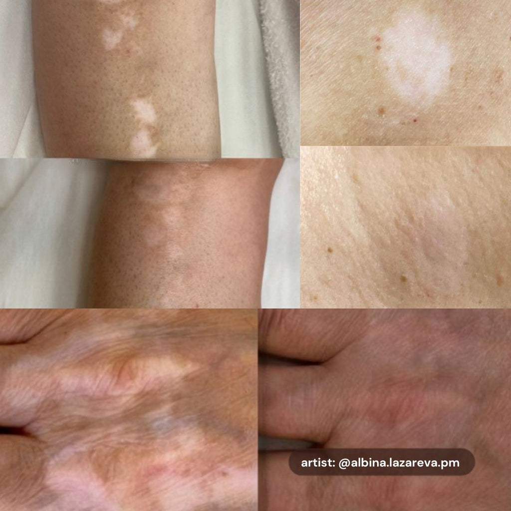 Resultados de camuflaje profesional con Etalon Mix Skin 5 para corrección de alteraciones de pigmentación, cicatrices y reconstrucción cromática.