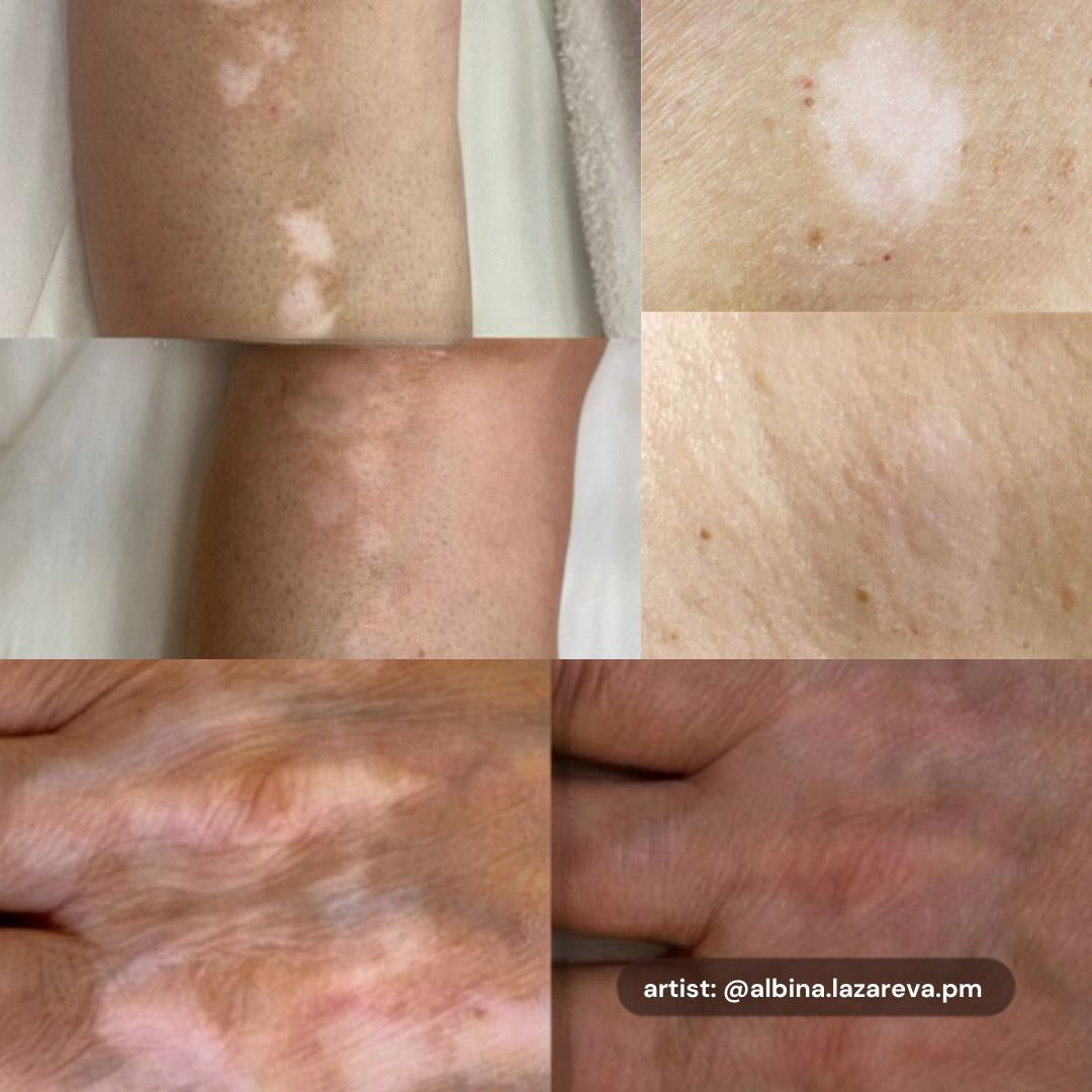 Resultados de camuflaje profesional en cicatrices y alteraciones de pigmentación con la gama Etalon Mix Skin.